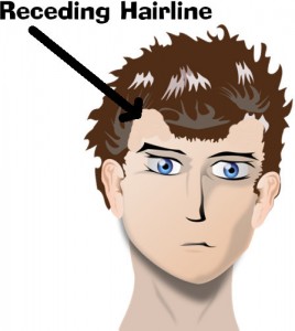 Typical graphic of a receding hairline representation.